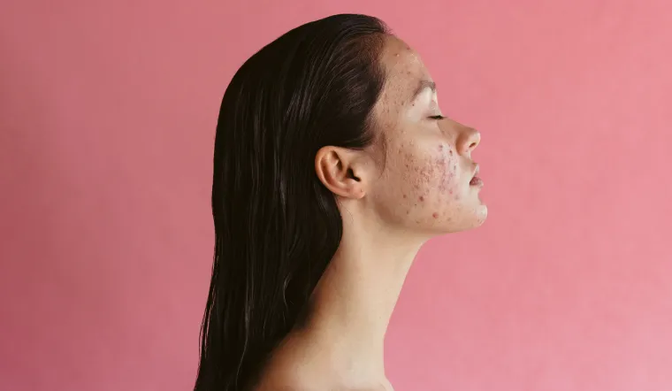 hormonal-acne