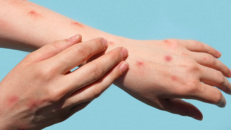 Monkey-Pox-Causes-&-Precautions