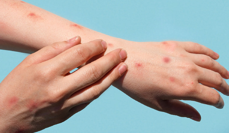 Monkey-Pox-Causes-&-Precautions